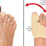 Orthopedic Bunion Pain Relief & Correction Sleeve (1 Pair) - HalluxCare™