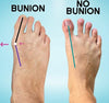 My Journey with Osteoporosis and Finding Bunion Relief