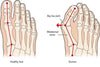 Bunion – Do I have one on my big toe? And If So, What Can I Do About It?