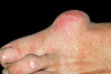 Bunions can cause bursitis, a painful condition that occurs when the fluid-filled sac (bursa) around the big toe joint becomes swollen and inflamed.