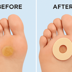 Callus Cushions - 15PCS Orthopedic  - Waterproof Self-Adhesive Foot Pads for Corn Removal & Bunion Protection