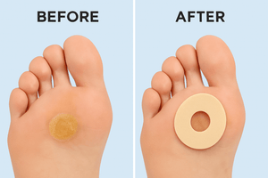 Callus Cushions - 15PCS Orthopedic  - Waterproof Self-Adhesive Foot Pads for Corn Removal & Bunion Protection