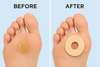 Callus Cushions - 15PCS Orthopedic  - Waterproof Self-Adhesive Foot Pads for Corn Removal & Bunion Protection