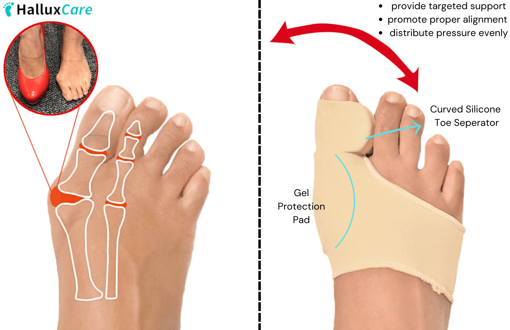 Bunion Pain Treatments: Shrink Bunions Naturally