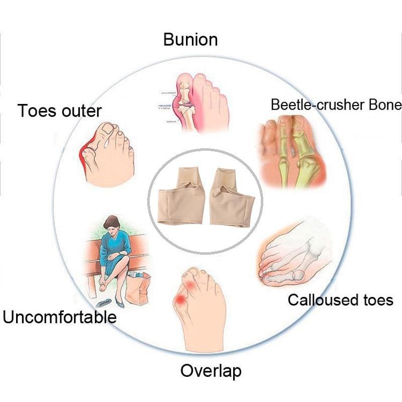 Orthopedic Bunion Pain Relief & Correction Sleeve (1 Pair) - HalluxCare™